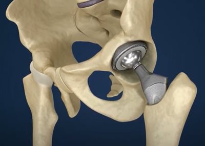 Implante articular personalizado para cirugía ortopédica personalizada.