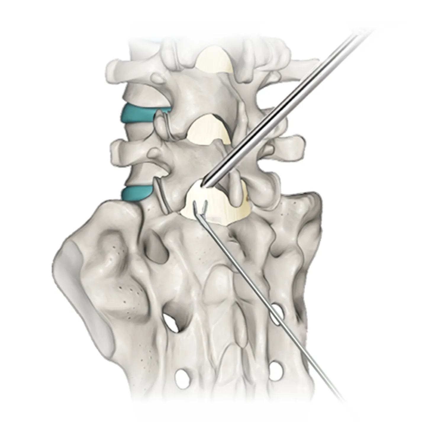 Orthopedic Spinal Implants Types Materials and Manufacturing Trends Tipos de implantes ortopédicos de columna, materiales y tendencias de fabricación