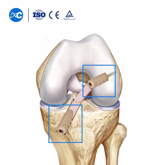 Tornillo de anclaje de sutura PEEK (ACL/PCL)