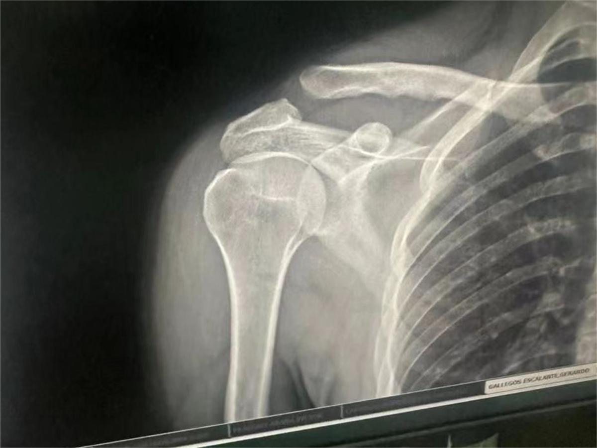¿Qué situaciones requieren implantes traumáticos?
