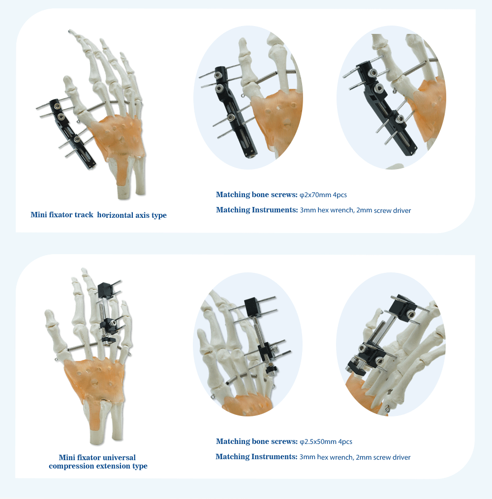 Fijaci&oacute;n externa de metacarpianos y falanges - Imagen 4 