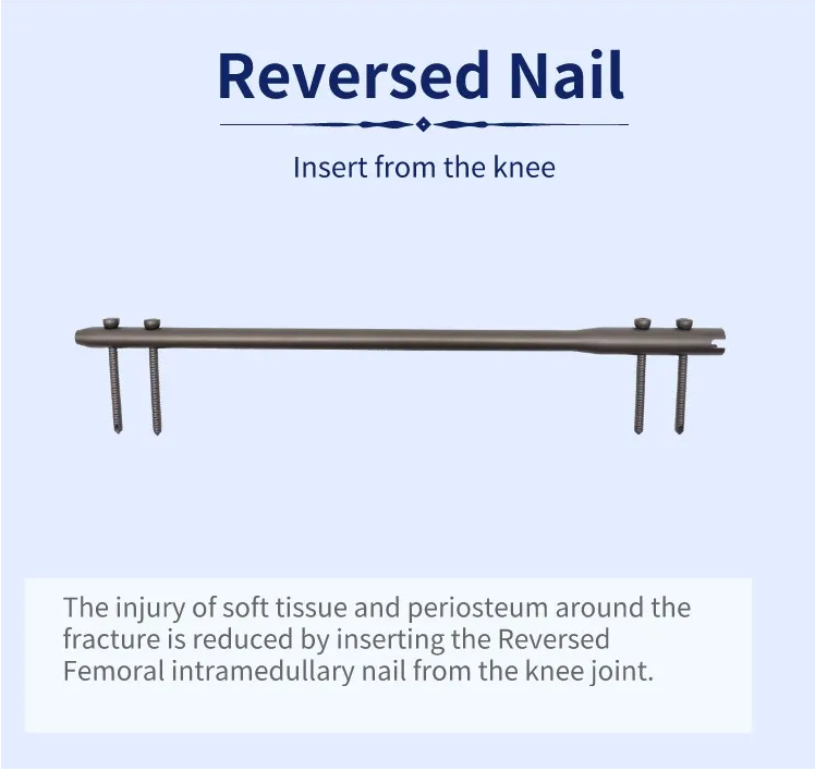 Clavo intramedular femoral invertido-2