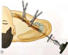 Estabilizaci&oacute;n de fractura intramedular de clav&iacute;cula
