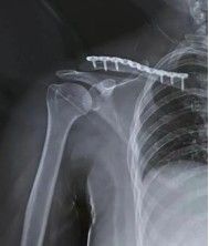 Osteos&iacute;ntesis con placa m&iacute;nimamente invasiva de la clav&iacute;cula.