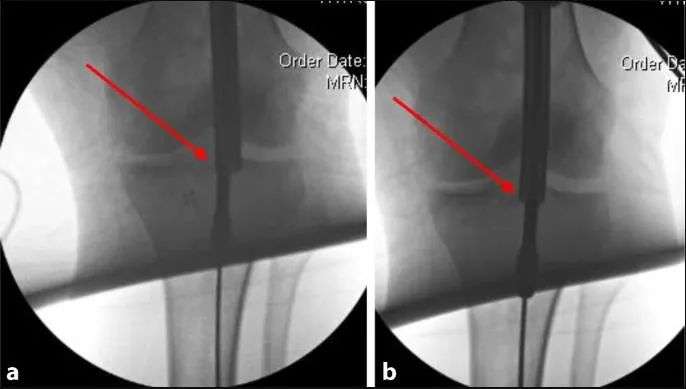 Fracturas de tibia, t&eacute;cnica de clavo intramedular suprapatelar-23