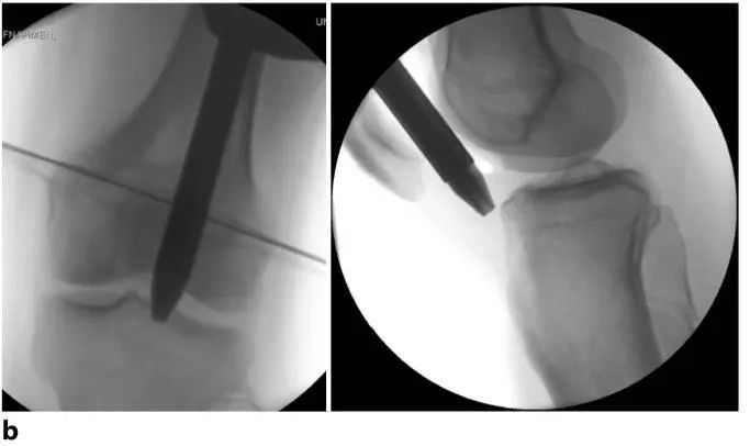 Fracturas de tibia, t&eacute;cnica de clavo intramedular suprapatelar-8