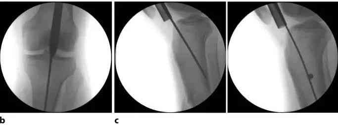 Fracturas de tibia, t&eacute;cnica de clavo intramedular suprapatelar-11