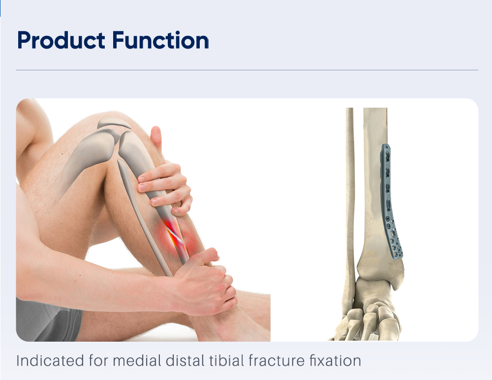 Placa poliaxial medial para tibia distal - Compre producto en XC Medico 