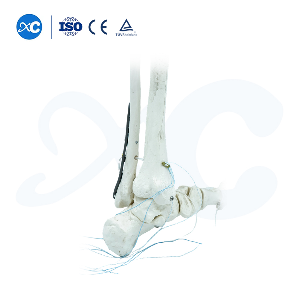 Placa de bloqueo tibioperoneo distal-III