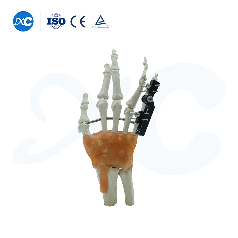 Fijación Externa Para Metacarpianos Y Falanges