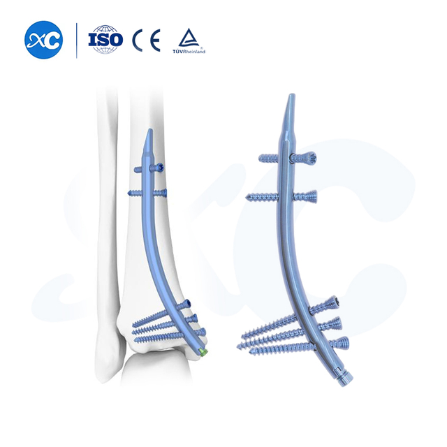 Clavo intramedular tibial distal: fijación retrógrada