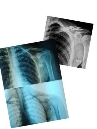 Patr&oacute;n de desplazamiento de una fractura de clav&iacute;cula.