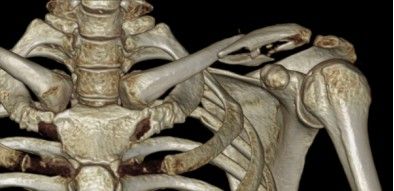 Diagn&oacute;stico por im&aacute;genes del desplazamiento de fractura de clav&iacute;cula.