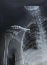 Fractura de clav&iacute;cula tratada con fijaci&oacute;n con placa m&iacute;nimamente invasiva