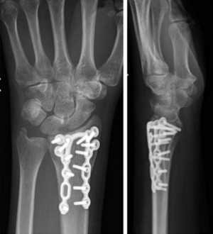 Colocaci&oacute;n de la placa dorsal en una fractura del radio distal 