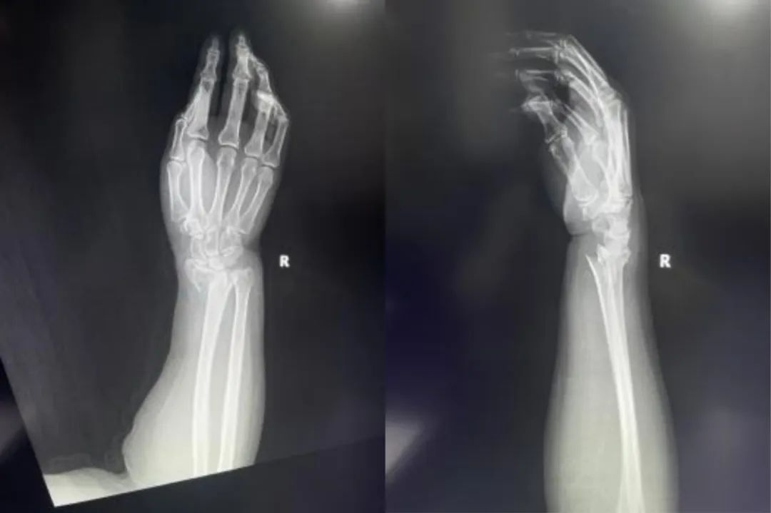 Construcci&oacute;n de placa de bloqueo volar para una fractura intraarticular de radio distal 