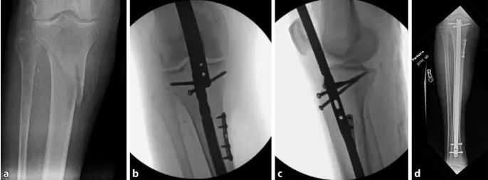 Fracturas de tibia, t&eacute;cnica de clavo intramedular suprapatelar-21