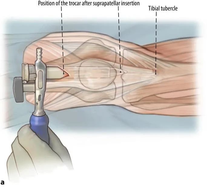 Fracturas de tibia, t&eacute;cnica de clavo intramedular suprapatelar-7