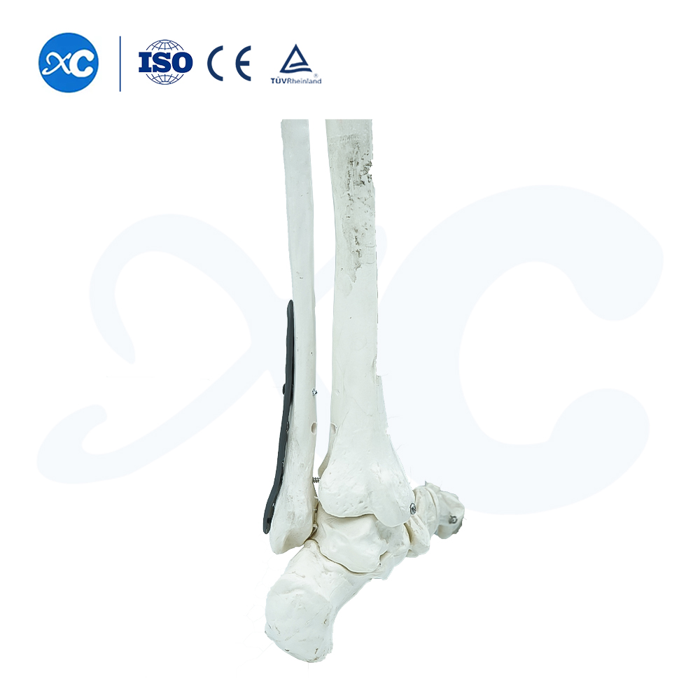 Placa de bloqueo para tibioperoneo distal-I