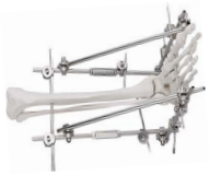 Fijador combinado para articulaci&oacute;n del tobillo