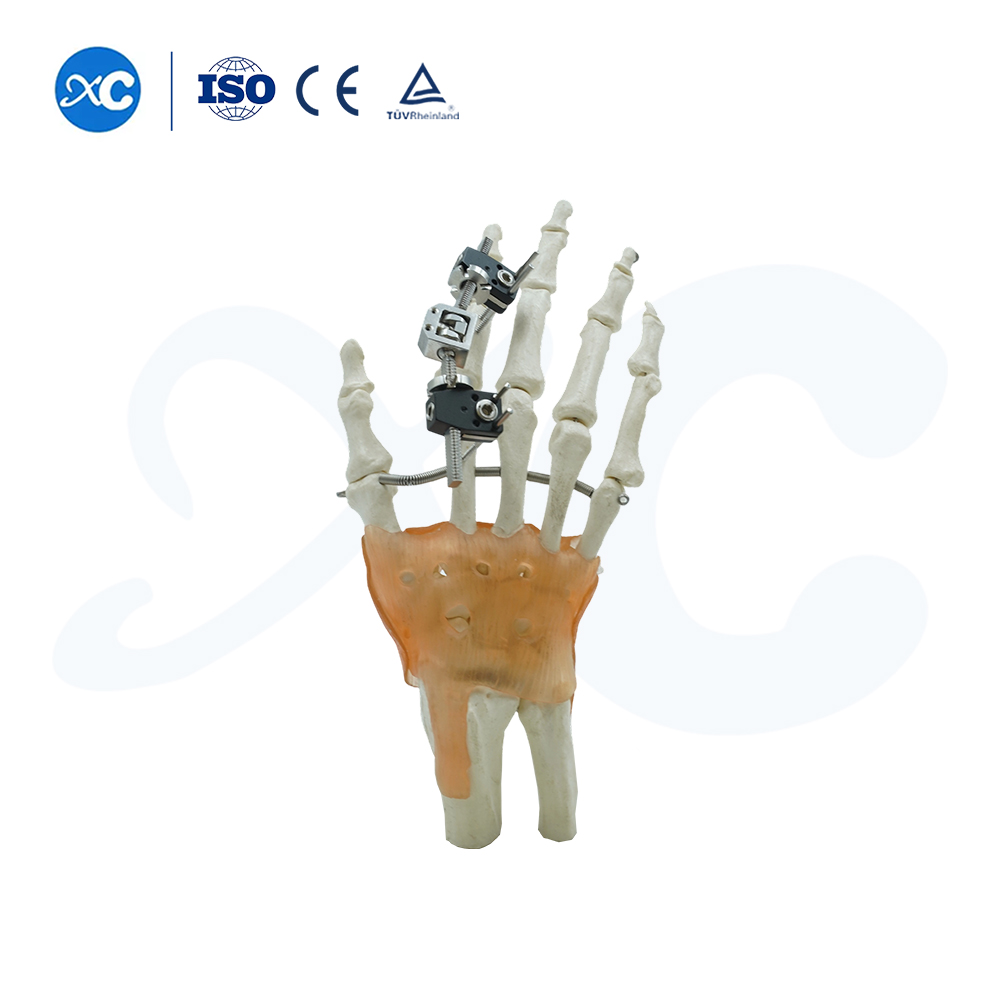 Mini Sistema de Fijación Externa para Metacarpianos y Falanges