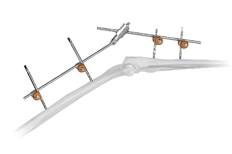 Sistema de fijación externa combinacional y modular