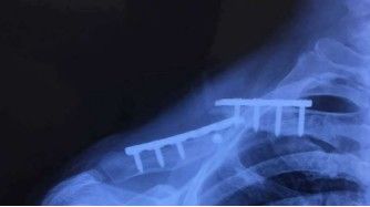 Complicaci&oacute;n postratamiento de una fractura de clav&iacute;cula.