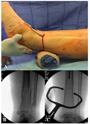 T&eacute;cnica de reducci&oacute;n percut&aacute;nea con pinza durante la cirug&iacute;a del clavo intramedular tibial