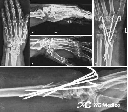 Fractura conminuta de radio distal que requiere evaluaci&oacute;n de fijaci&oacute;n suplementaria 