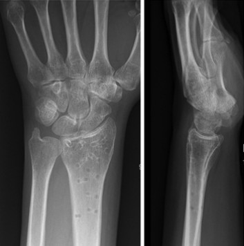 Radiograf&iacute;a despu&eacute;s de la fijaci&oacute;n con placa dorsal de una fractura del radio distal