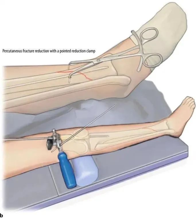 Fracturas de tibia, t&eacute;cnica de clavo intramedular suprapatelar-15