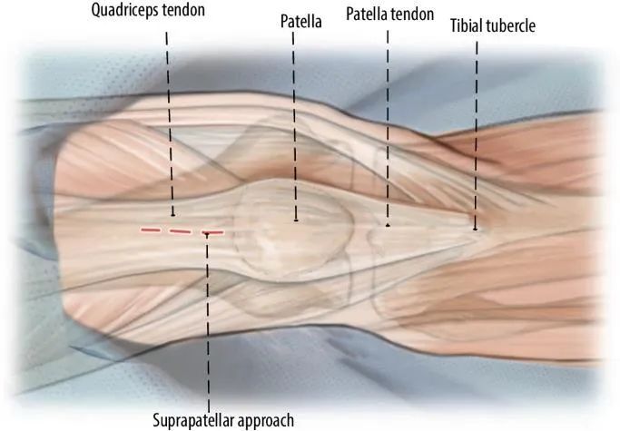 Fracturas de tibia, t&eacute;cnica de clavo intramedular suprapatelar-5