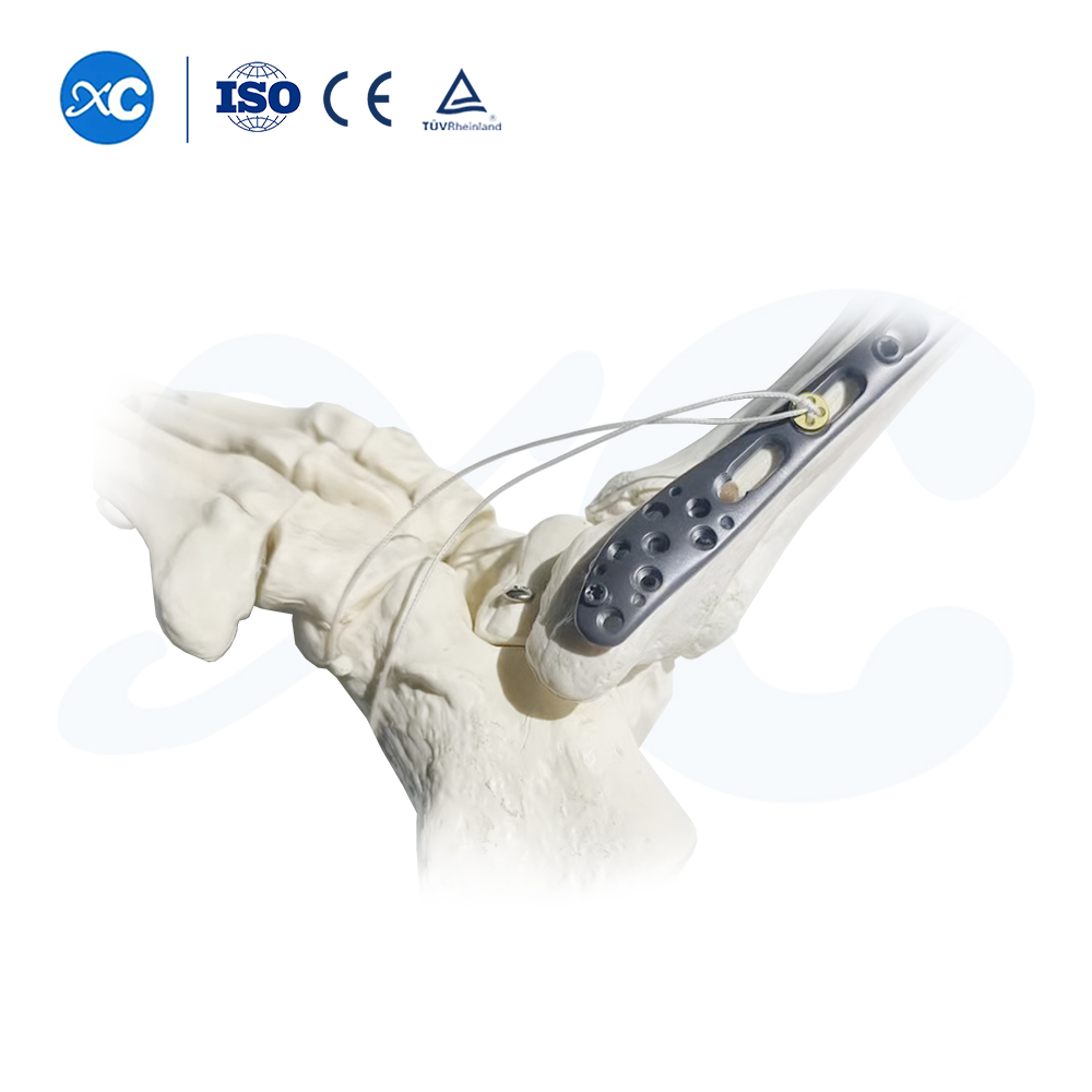 Placa de bloqueo tibioperoneo distal-III