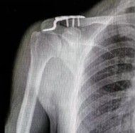 Fijaci&oacute;n con placa de una fractura de clav&iacute;cula distal
