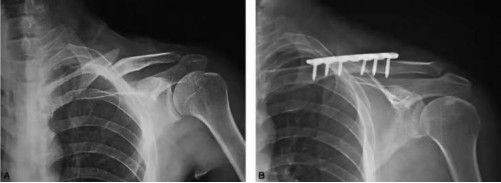 Fijaci&oacute;n con placa y tornillos de una fractura de clav&iacute;cula.