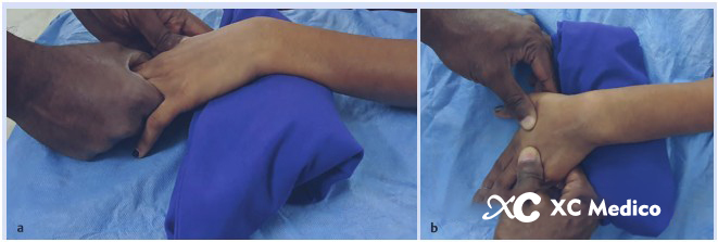 Configuraci&oacute;n de fijaci&oacute;n percut&aacute;nea con aguja de Kirschner para una fractura de radio distal 