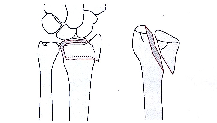 Ilustraci&oacute;n de fractura por cizallamiento del radio distal tipo II de Fern&aacute;ndez 