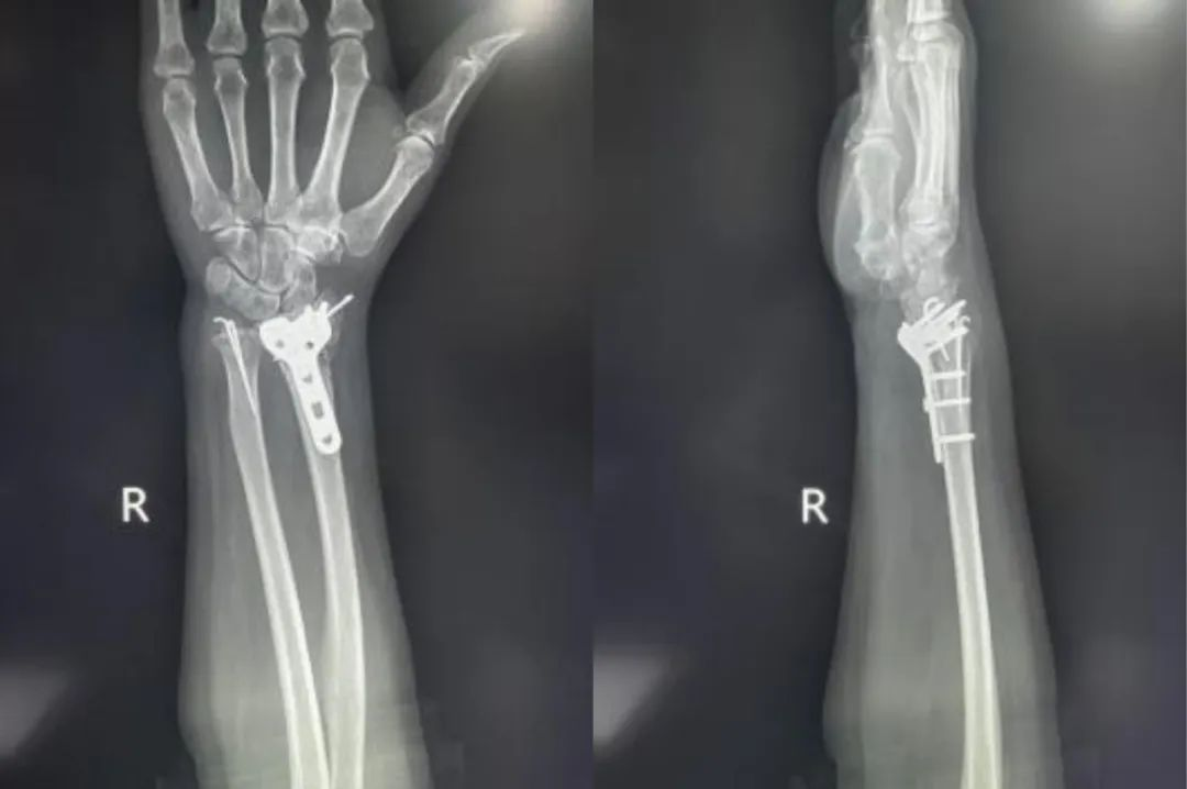 Resultado radiogr&aacute;fico despu&eacute;s de la fijaci&oacute;n con placa volar de una fractura de radio distal