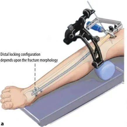 Fracturas de tibia, t&eacute;cnica de clavo intramedular suprapatelar-18