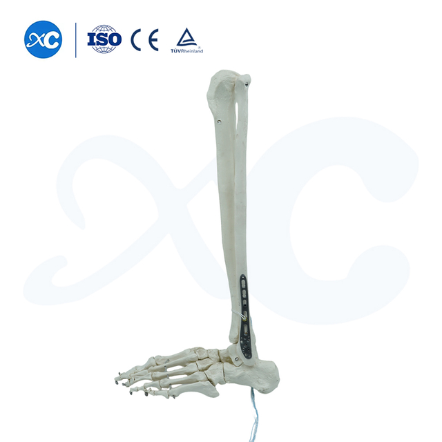 Placa de bloqueo tibioperoneo distal-III