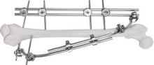 Fijador combinacional de di&aacute;fisis femoral