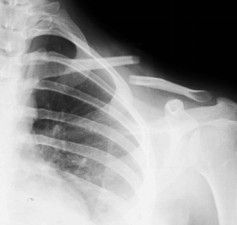 Anatom&iacute;a del desplazamiento de la fractura de clav&iacute;cula.