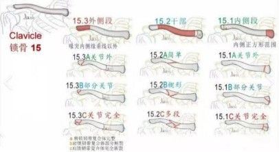Clasificaci&oacute;n AO OTA de fracturas de clav&iacute;cula.