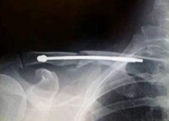 T&eacute;cnica de fijaci&oacute;n intramedular para fractura de clav&iacute;cula.