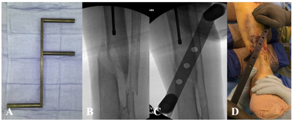 T&eacute;cnica de reducci&oacute;n cerrada utilizando instrumentos de reducci&oacute;n antes de la fijaci&oacute;n del clavo intramedular tibial.