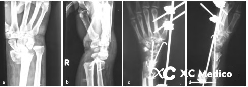 Opci&oacute;n de fijaci&oacute;n externa de mu&ntilde;eca para una fractura de radio distal conminuta fractura de radio