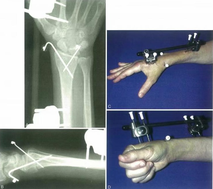 Radiograf&iacute;a de fijaci&oacute;n externa que estabiliza una fractura de radio distal