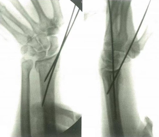 Placa de puente dorsal que abarca una fractura conminuta de radio distal