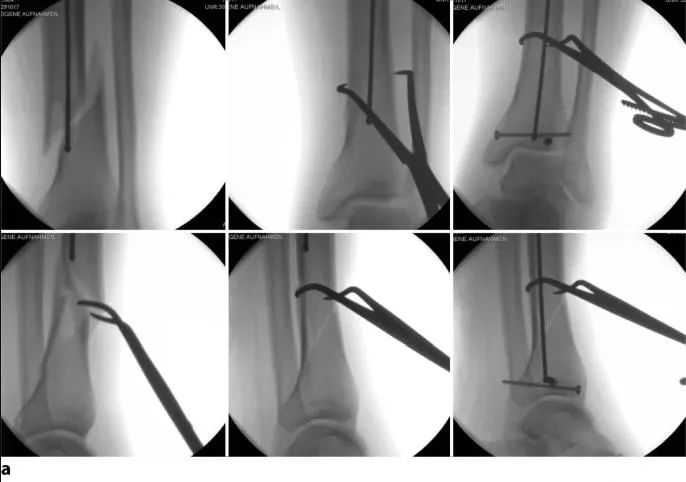 Fracturas de tibia, t&eacute;cnica de clavo intramedular suprapatelar-14