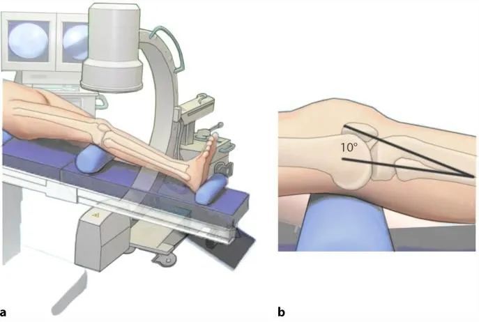 Fracturas de tibia, t&eacute;cnica de clavo intramedular suprapatelar-4